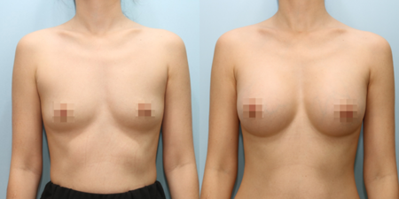 겨드랑이 절개하 첫수술
모티바 보형물 수술 전후