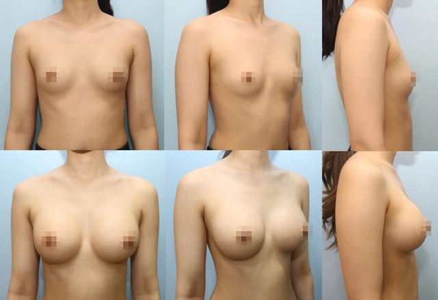 겨드랑이 절개하 첫수술 상세 전후사진
