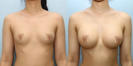 겨드랑이 절개하 첫수술 수술 전후사진: 케이스 2