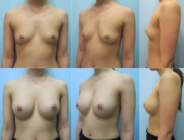겨드랑이 절개하 첫수술 상세 전후사진