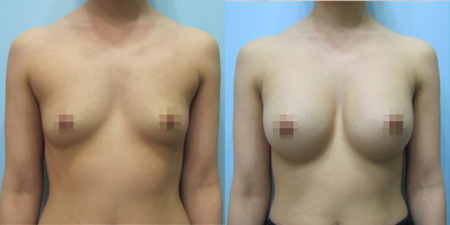 겨드랑이 절개하 첫수술
멘토 보형물 수술 전후