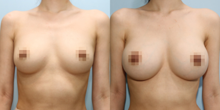 겨드랑이 절개하 첫수술
멘토 보형물 수술 전후