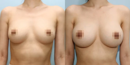 겨드랑이 절개하 첫수술 수술 전후사진: 케이스 5