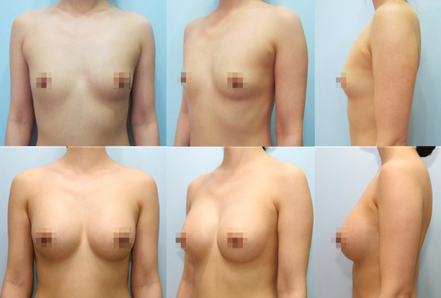겨드랑이 절개하 첫수술 상세 전후사진