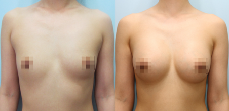 겨드랑이 절개하 첫수술
모티바 보형물 수술 전후