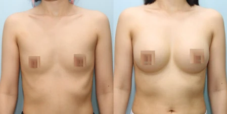 겨드랑이 절개하 첫수술 수술 전후사진: 케이스 7