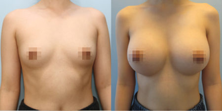 겨드랑이 절개하 첫수술
모티바 보형물 수술 전후