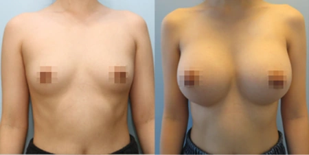 겨드랑이 절개하 첫수술 수술 전후사진: 케이스 10