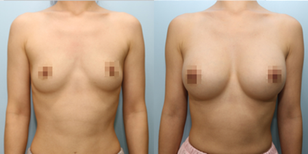 겨드랑이 절개하 첫수술
모티바 보형물 수술 전후
