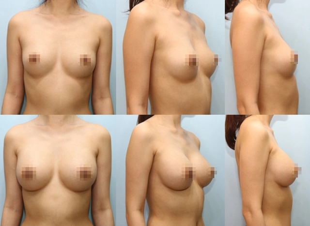 겨드랑이 절개하 첫수술 상세 전후사진