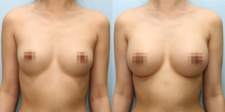겨드랑이 절개하 첫수술
모티바 보형물 수술 전후