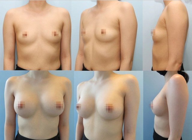 겨드랑이 절개하 첫수술 상세 전후사진