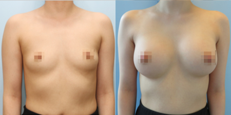 겨드랑이 절개하 첫수술
모티바 보형물 수술 전후