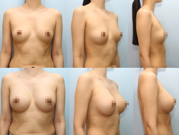 겨드랑이 절개하 첫수술 상세 전후사진