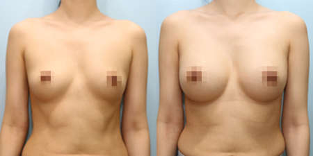 겨드랑이 절개하 첫수술
세빈 보형물 수술 전후