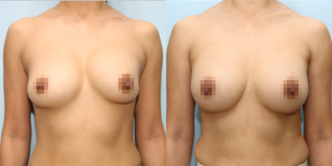 겨드랑이 절개하 재수술
모티바 보형물 수술 전후