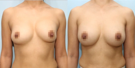 겨드랑이 절개하 재수술 수술 전후사진: 케이스 24