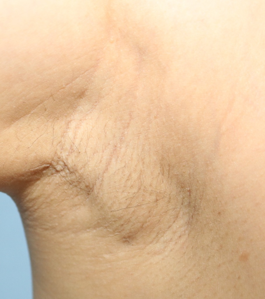 겨드랑이 절개 6개월 후