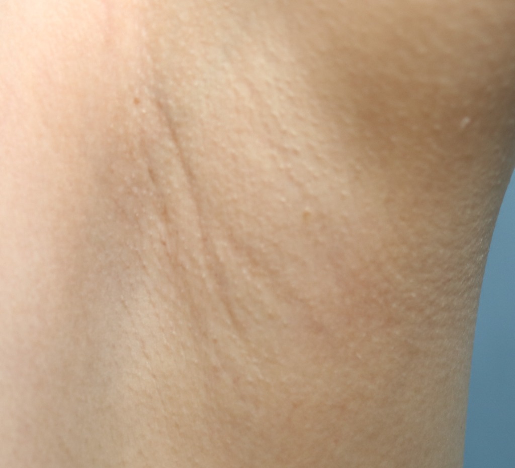 겨드랑이 절개 6개월 후