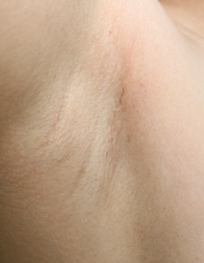 겨드랑이 절개 6개월 후