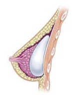 유선하 삽입 단면도: 보형물이 대흉근 위, 유선 아래에 위치한 모습(FDA 자료)
