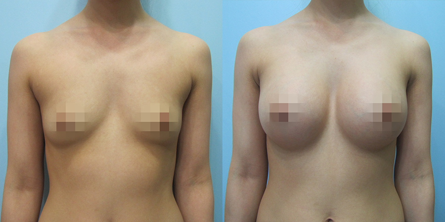 겨드랑이 절개하 첫수술
멘토 보형물 수술 전후