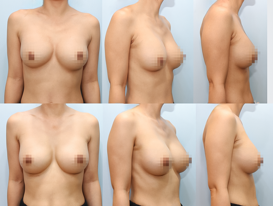 겨드랑이 절개하 재수술 상세 전후사진
