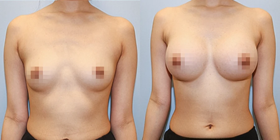 Transaxillary primary augmentation before and after photo