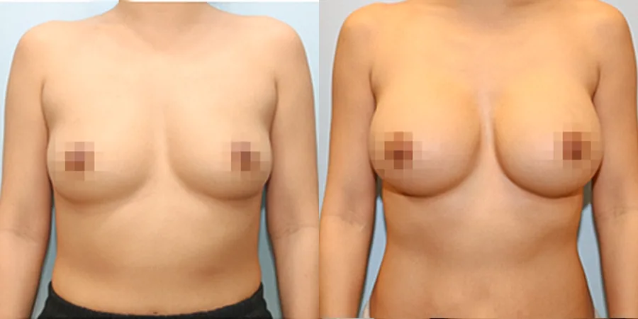 Transaxillary primary augmentation before and after photo