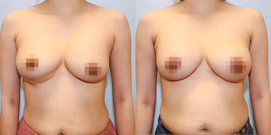 Transaxillary revision surgery before and after photo