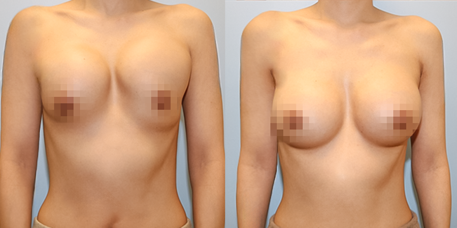 겨드랑이 절개하 재수술
멘토 보형물 수술 전후