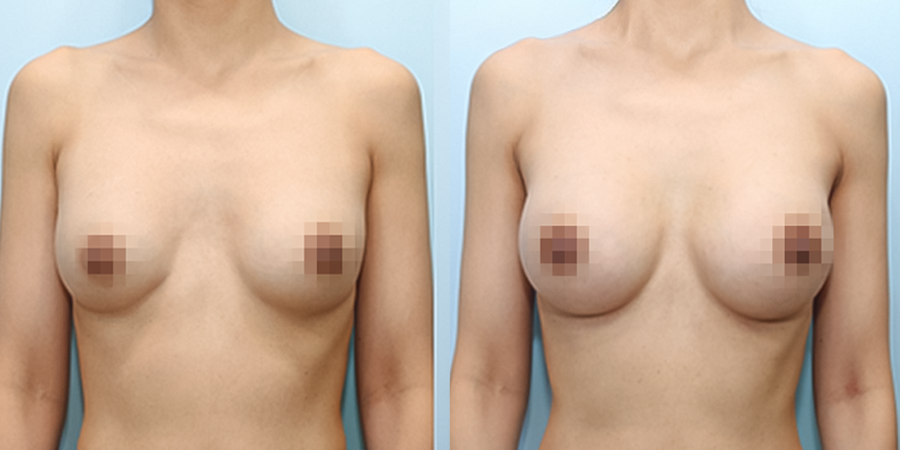 겨드랑이 절개하 재수술
멘토 보형물 수술 전후