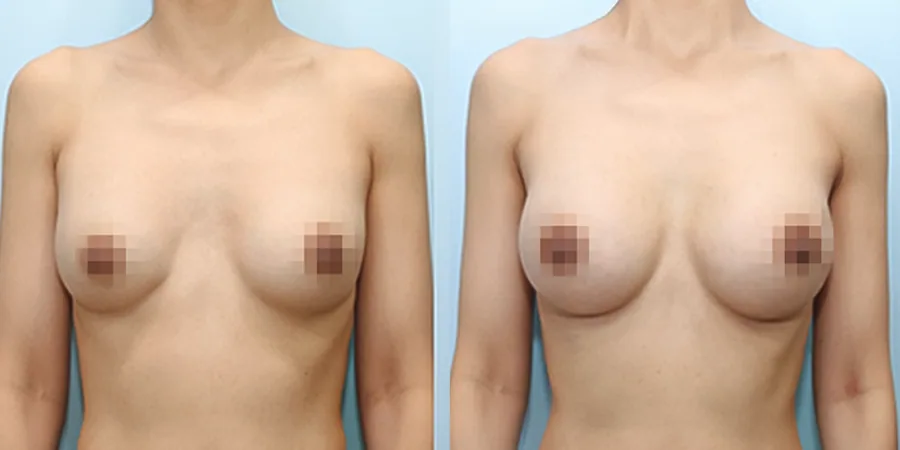 겨드랑이 절개하 재수술 수술 전후사진 — 케이스 28