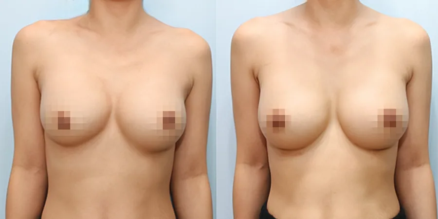 겨드랑이 절개하 재수술 수술 전후사진 — 케이스 27