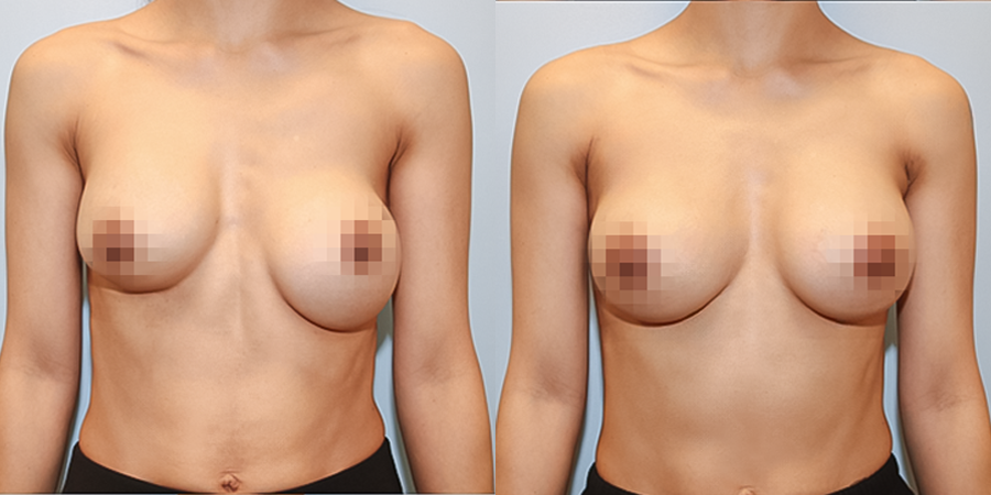 겨드랑이 절개하 재수술
멘토 보형물 수술 전후