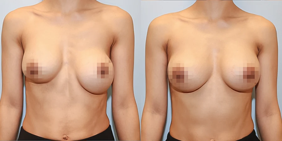 겨드랑이 절개하 재수술 수술 전후사진 — 케이스 26