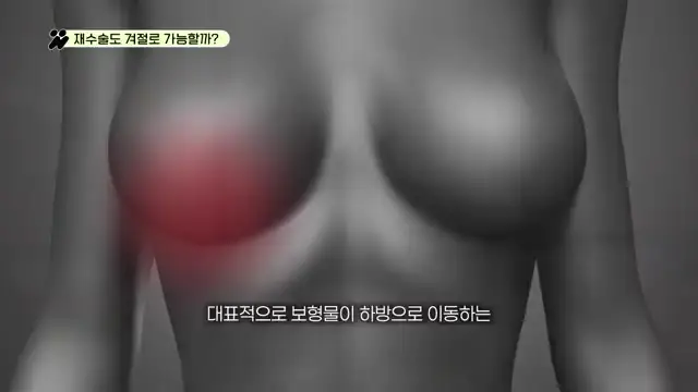 보형물이 하방으로 이동하는 밑빠짐 등 보형물 위치 변이를 나타낸 그림