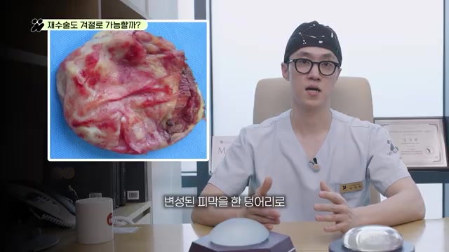 겨드랑이 절개로 한 덩어리로 깔끔하게 제거된 변성된 피막