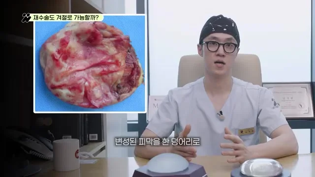 겨드랑이 절개로 한 덩어리로 깔끔하게 제거된 변성된 피막