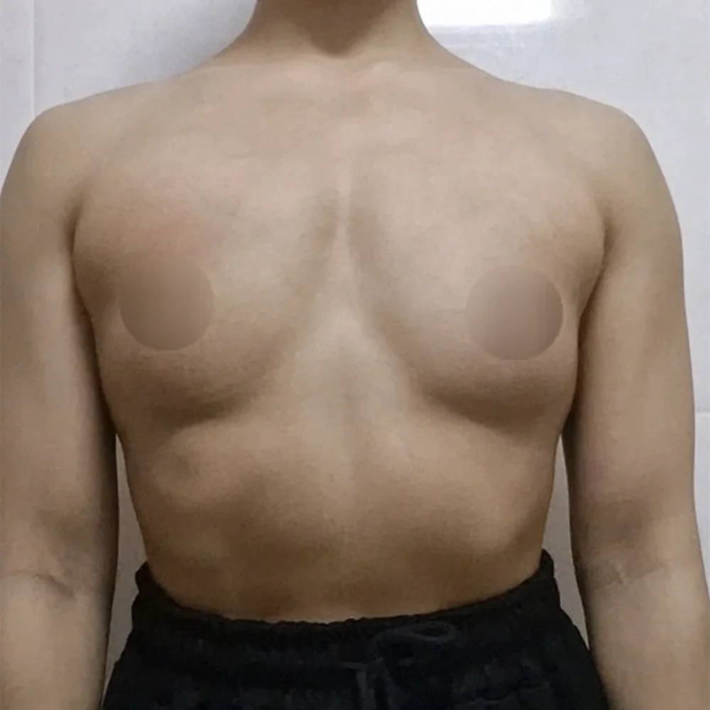 새가슴 볼륨 교정 · 가슴성형 후기 사진 1