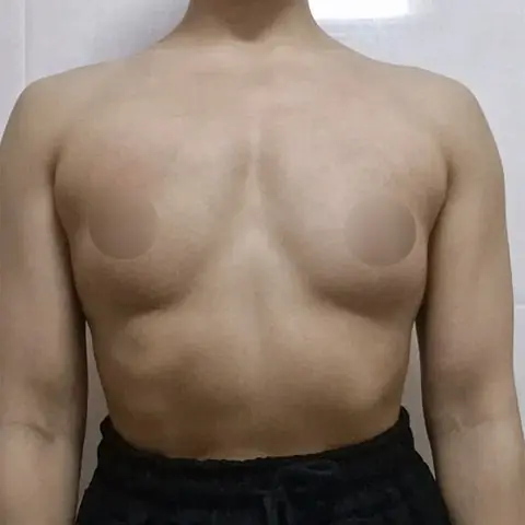 가슴성형 리얼후기 13: 엄나구모 가슴성형