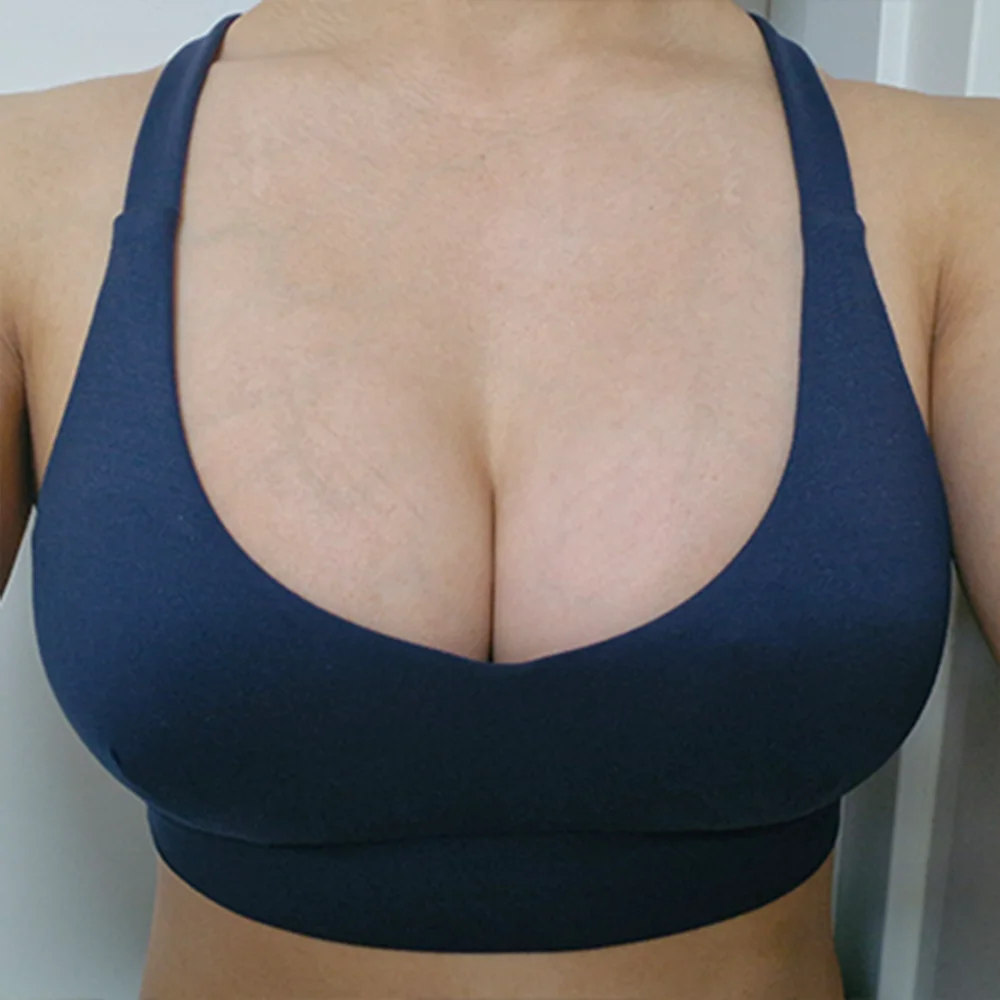 자연스러운 가슴성형 · 3개월차 · 모티바 · 가슴성형 후기 사진 2