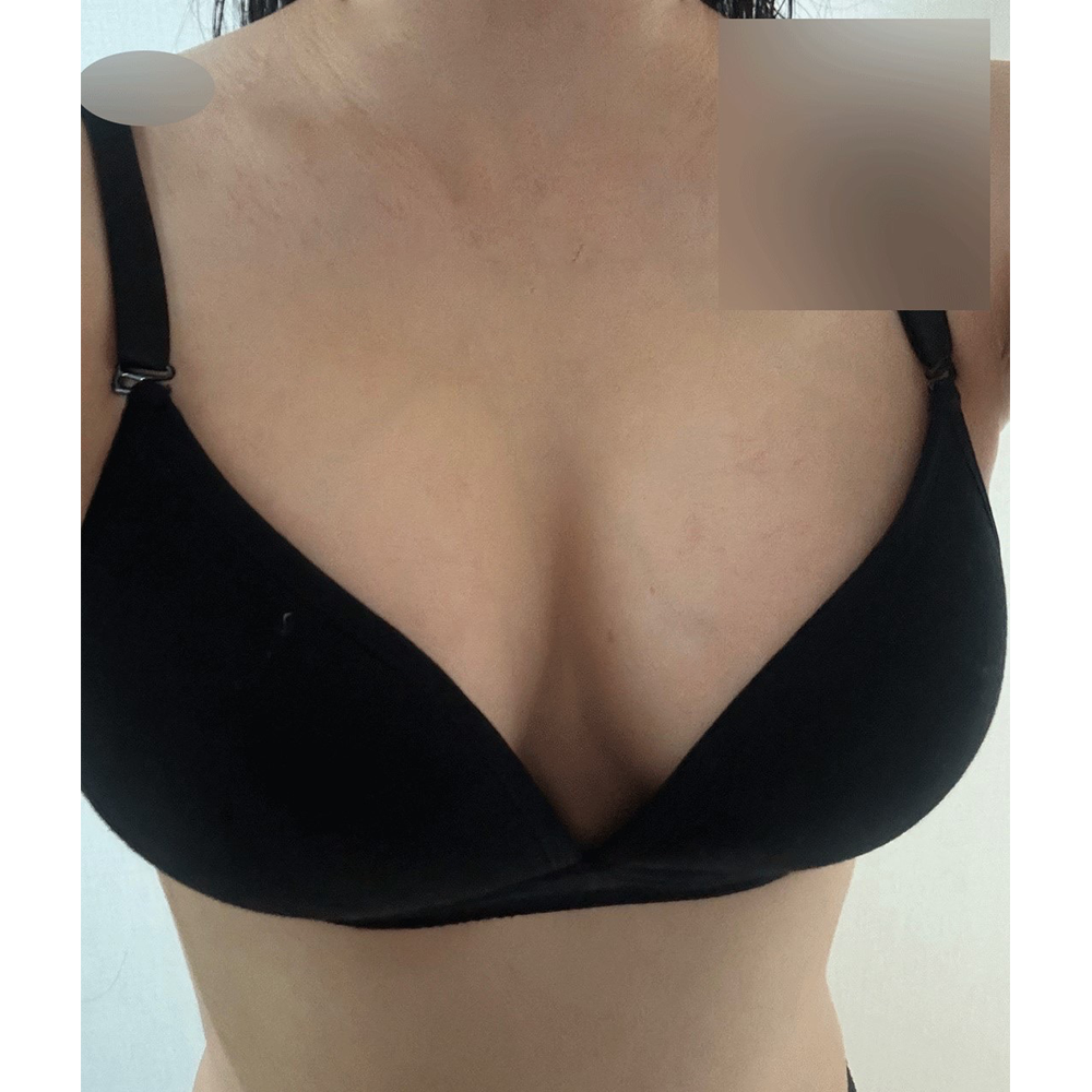 수술 후 - 리얼후기 5