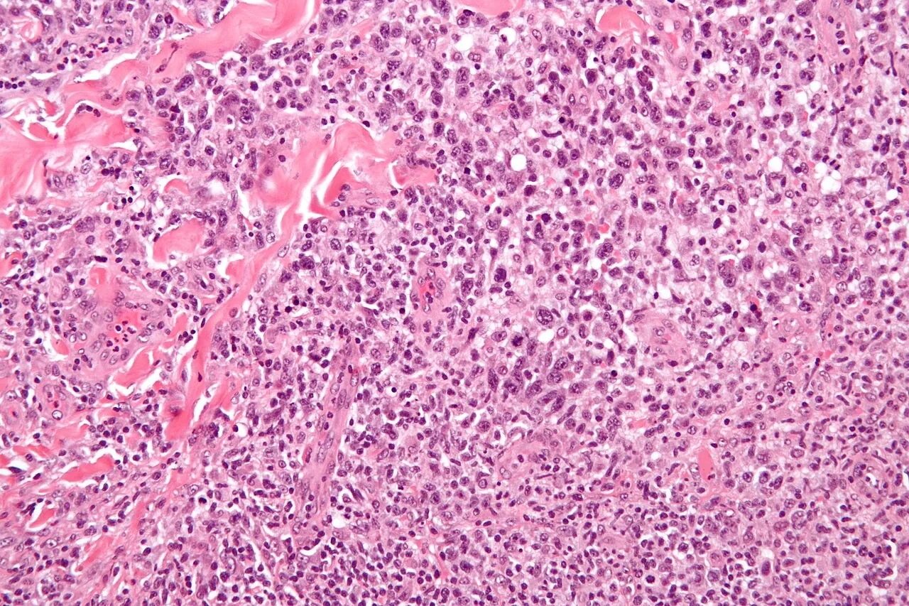 역형성 대세포 림프종 조직을 H&E 염색해 고배율로 본 현미경 사진