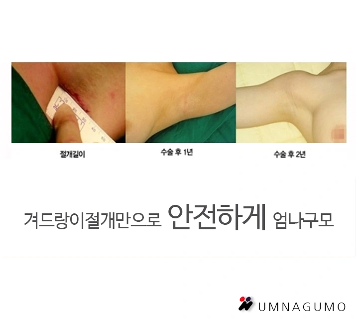 가슴보형물종류 너무 많아요 엄나구모성형외과 도와줘요!! 안내 이미지