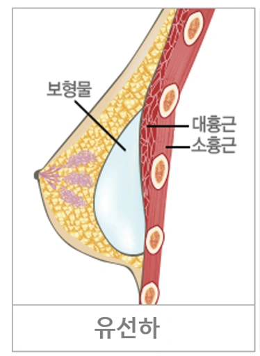 유선하 보형물 삽입 위치 단면 도해: 보형물이 유선 아래·대흉근 위에 위치