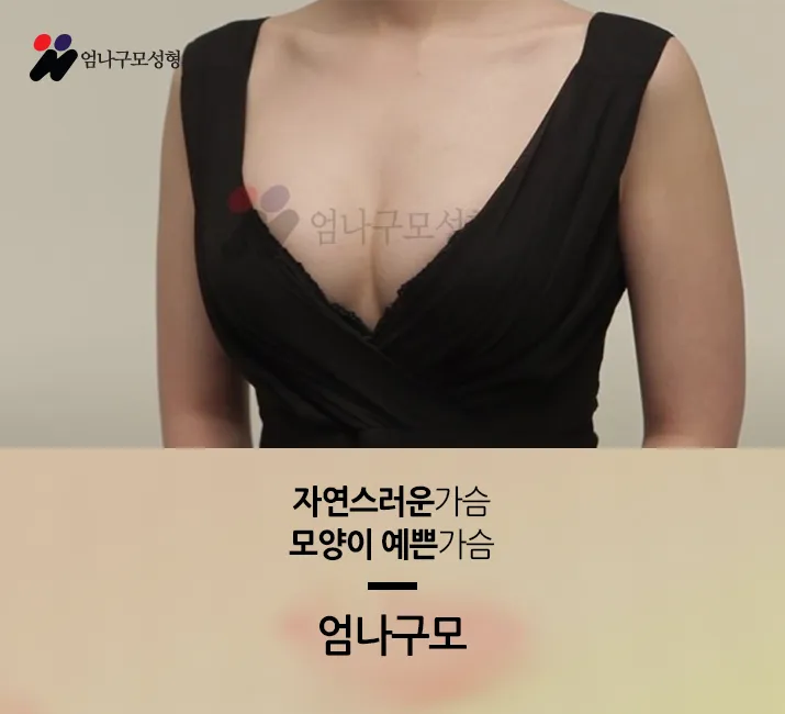 처진 가슴수술 가슴확대수술로?? 안내 이미지