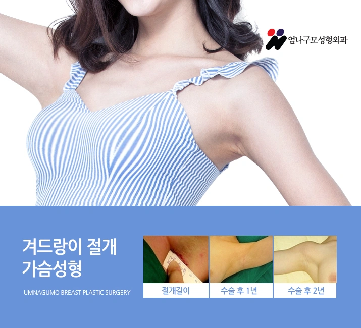 엄나구모 정보글>>가슴성형! 염증걱정없이 엄나구모! 안내 이미지