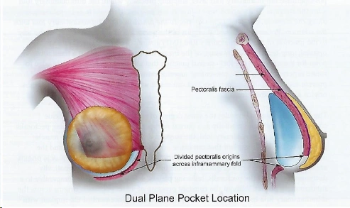 이중평면(Dual Plane) 보형물 포켓 위치 해부도: 대흉근 기시부 분리와 근막 표기