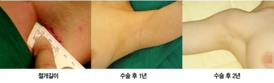 가슴수술 후 흉터자국 안내 이미지